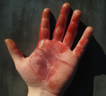 opekotina prvog stepena